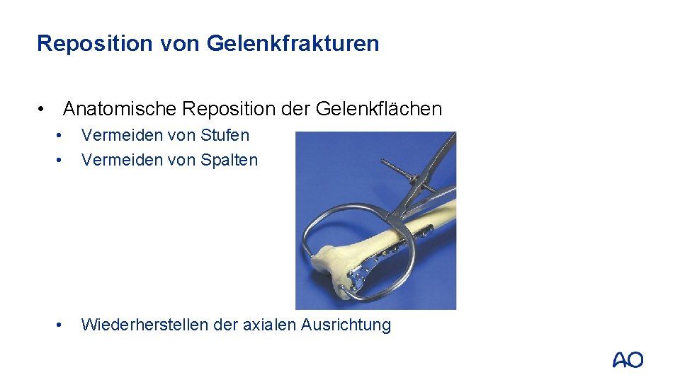 Reposition von Gelenkfrakturen • Anatomische Reposition der Gelenkflächen • • Vermeiden von Stufen Vermeiden