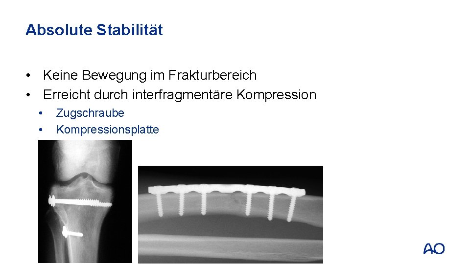 Absolute Stabilität • Keine Bewegung im Frakturbereich • Erreicht durch interfragmentäre Kompression • •