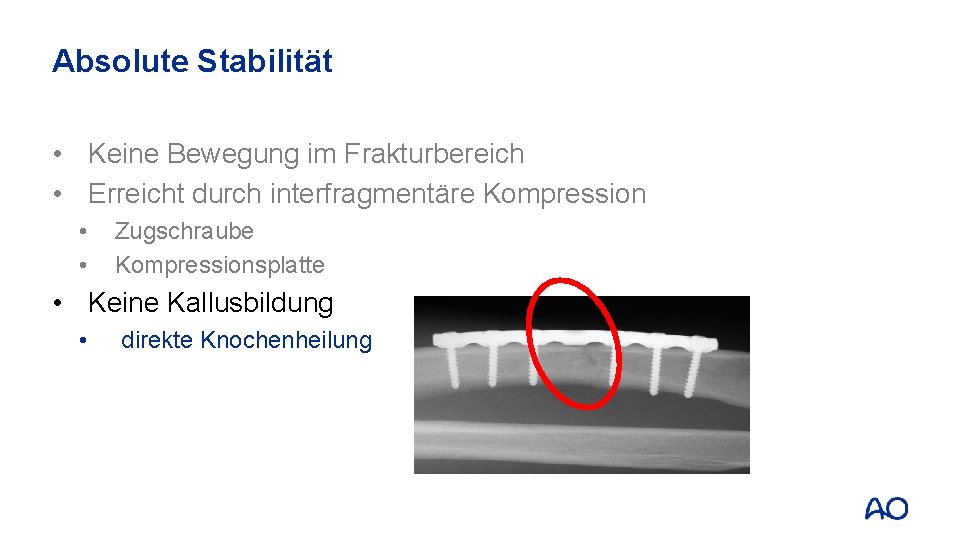 Absolute Stabilität • Keine Bewegung im Frakturbereich • Erreicht durch interfragmentäre Kompression • •