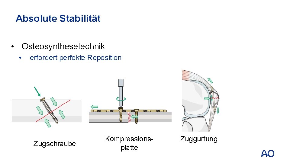 Absolute Stabilität • Osteosynthesetechnik • erfordert perfekte Reposition Zugschraube Kompressionsplatte Zuggurtung 