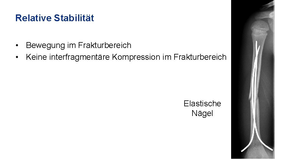 Relative Stabilität • Bewegung im Frakturbereich • Keine interfragmentäre Kompression im Frakturbereich Elastische Nägel
