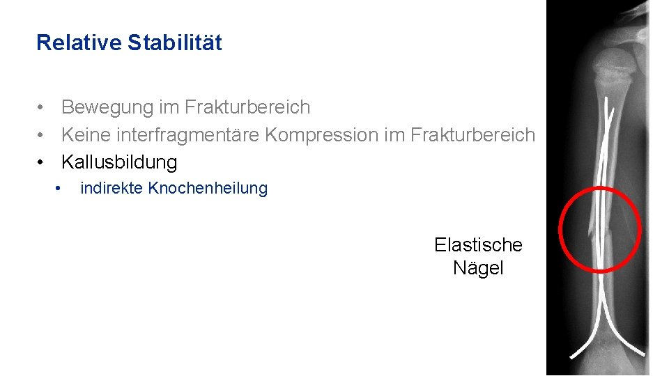 Relative Stabilität • Bewegung im Frakturbereich • Keine interfragmentäre Kompression im Frakturbereich • Kallusbildung