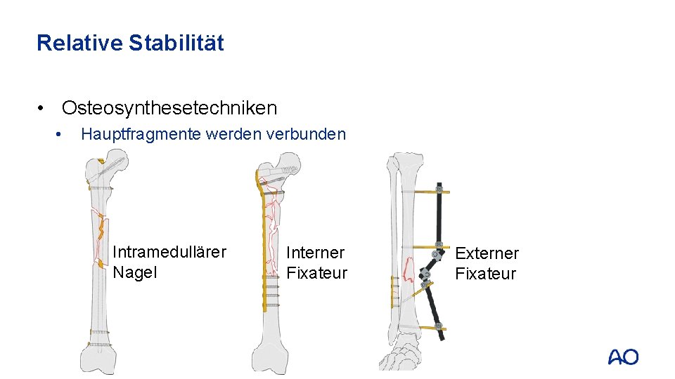 Relative Stabilität • Osteosynthesetechniken • Hauptfragmente werden verbunden Intramedullärer Nagel Interner Fixateur Externer Fixateur