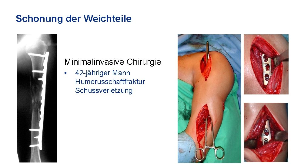 Schonung der Weichteile Minimalinvasive Chirurgie • 42 -jähriger Mann Humerusschaftfraktur Schussverletzung 