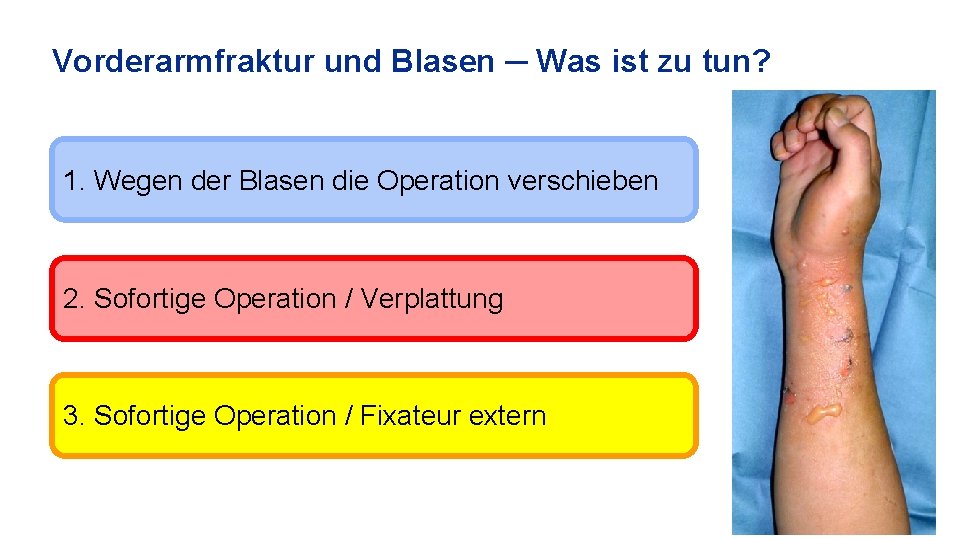 Vorderarmfraktur und Blasen ─ Was ist zu tun? 1. Wegen der Blasen die Operation