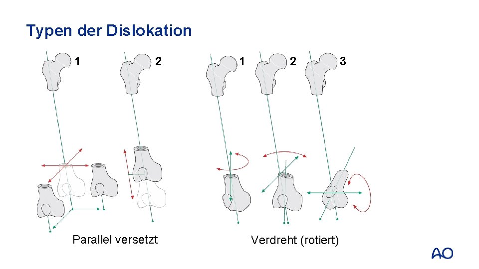Typen der Dislokation 1 2 Parallel versetzt 1 2 Verdreht (rotiert) 3 