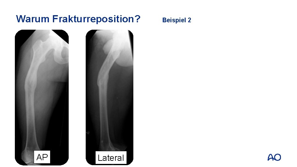 Warum Frakturreposition? AP Lateral Beispiel 2 