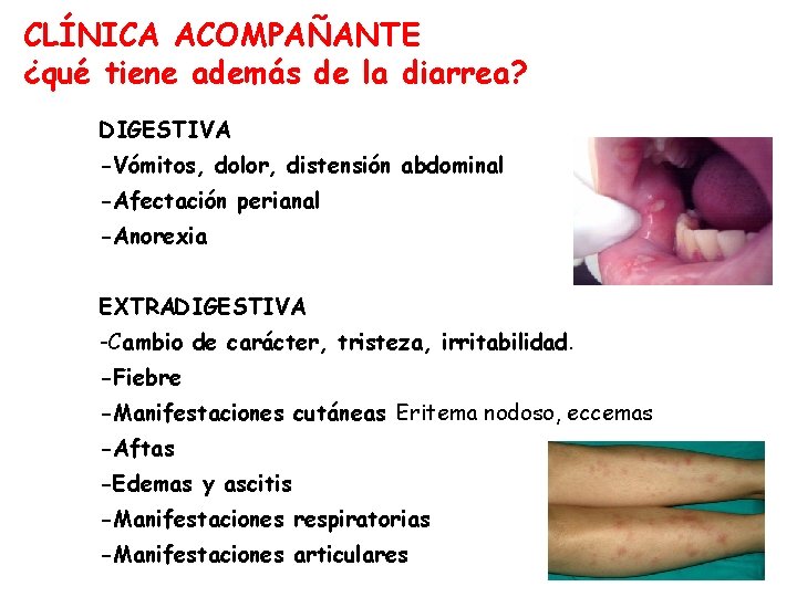 CLÍNICA ACOMPAÑANTE ¿qué tiene además de la diarrea? DIGESTIVA -Vómitos, dolor, distensión abdominal -Afectación
