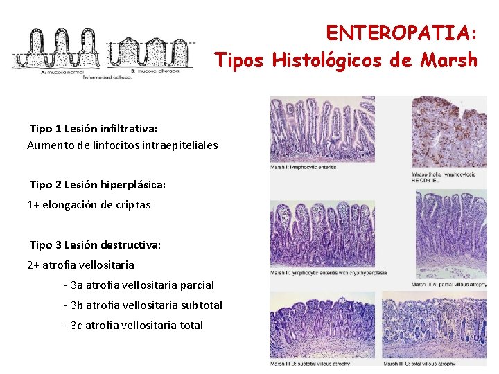 ENTEROPATIA: Tipos Histológicos de Marsh Tipo 1 Lesión infiltrativa: Aumento de linfocitos intraepiteliales Tipo