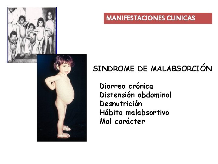 MANIFESTACIONES CLINICAS SINDROME DE MALABSORCIÓN Diarrea crónica Distensión abdominal Desnutrición Hábito malabsortivo Mal carácter