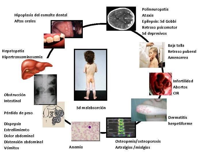 Polineuropatía Ataxia Epilepsia: Sd Gobbi Retraso psicomotor Sd depresivos Hipoplasia del esmalte dental Aftas