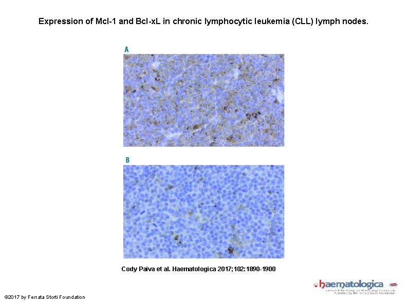 Expression of Mcl-1 and Bcl-x. L in chronic lymphocytic leukemia (CLL) lymph nodes. Cody