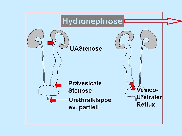 Hydronephrose UAStenose Prävesicale Stenose Urethralklappe ev. partiell Vesico. Uretraler Reflux 