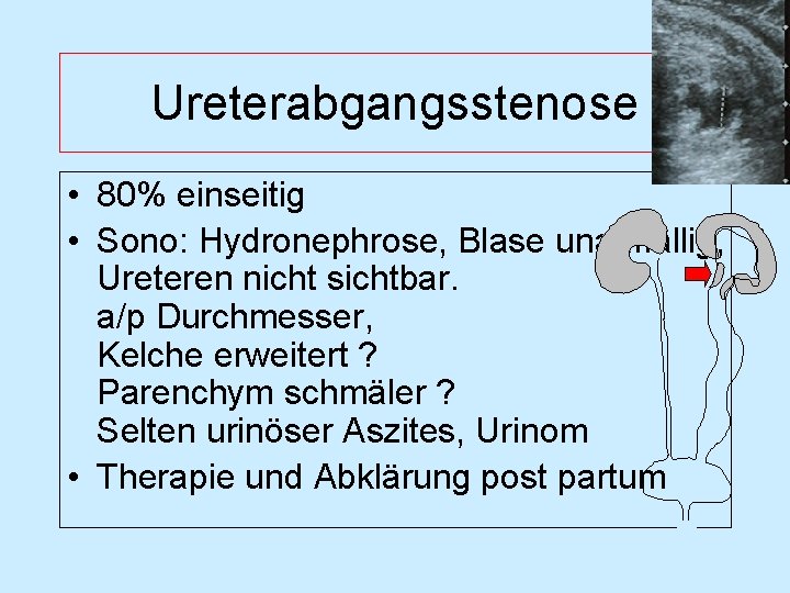 Ureterabgangsstenose • 80% einseitig • Sono: Hydronephrose, Blase unauffällig, Ureteren nicht sichtbar. a/p Durchmesser,