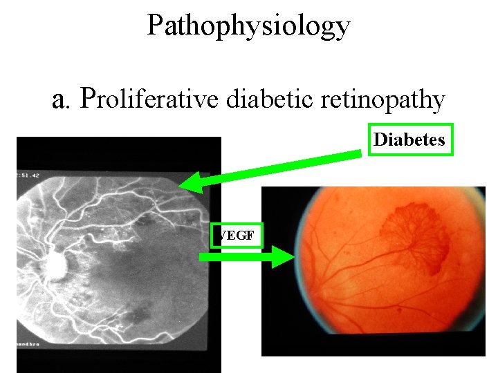 Pathophysiology a. Proliferative diabetic retinopathy Diabetes VEGF 