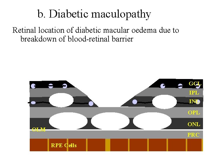 b. Diabetic maculopathy Retinal location of diabetic macular oedema due to breakdown of blood-retinal
