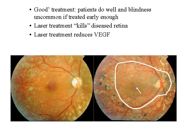  • Good’ treatment: patients do well and blindness uncommon if treated early enough