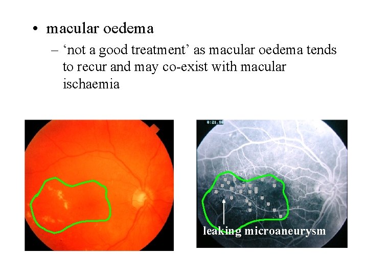  • macular oedema – ‘not a good treatment’ as macular oedema tends to