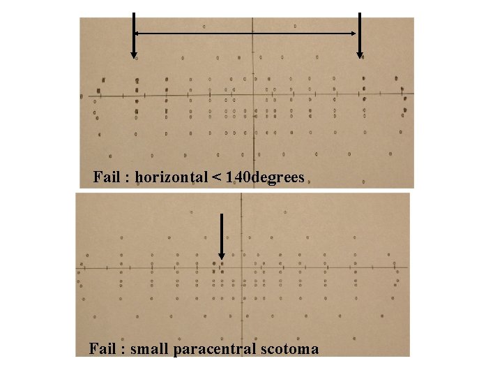 Fail : horizontal < 140 degrees Fail : small paracentral scotoma 