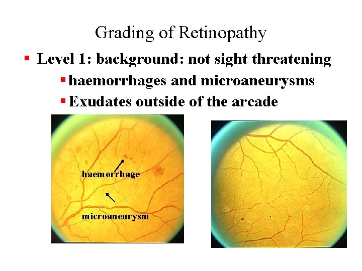 Grading of Retinopathy § Level 1: background: not sight threatening § haemorrhages and microaneurysms