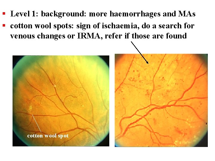 § Level 1: background: more haemorrhages and MAs § cotton wool spots: sign of