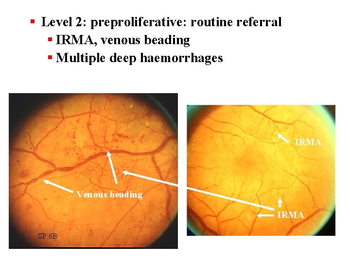 § Level 2: preproliferative: routine referral § IRMA, venous beading § Multiple deep haemorrhages