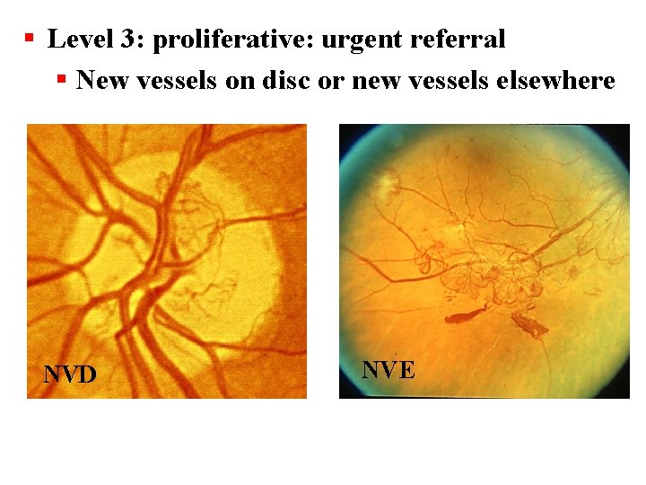 § Level 3: proliferative: urgent referral § New vessels on disc or new vessels