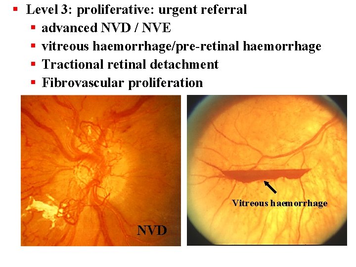 § Level 3: proliferative: urgent referral § advanced NVD / NVE § vitreous haemorrhage/pre-retinal