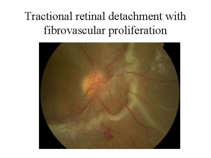 Tractional retinal detachment with fibrovascular proliferation 