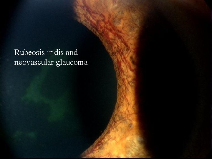 Rubeosis iridis and neovascular glaucoma 