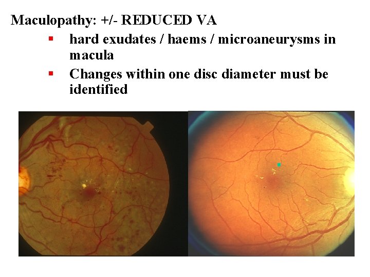 Maculopathy: +/- REDUCED VA § hard exudates / haems / microaneurysms in macula §