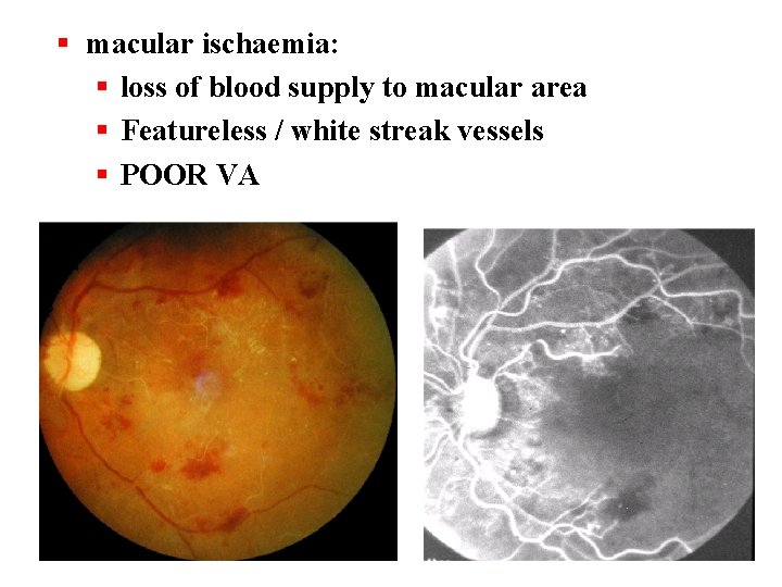 § macular ischaemia: § loss of blood supply to macular area § Featureless /
