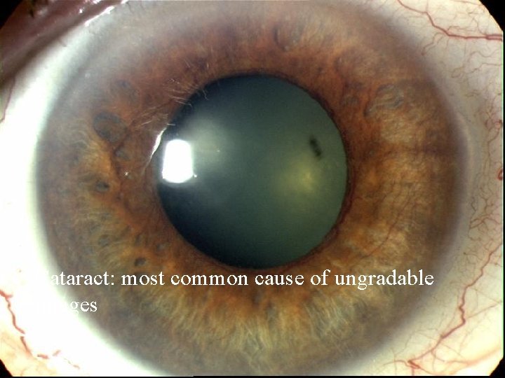 Cataract: most common cause of ungradable images 