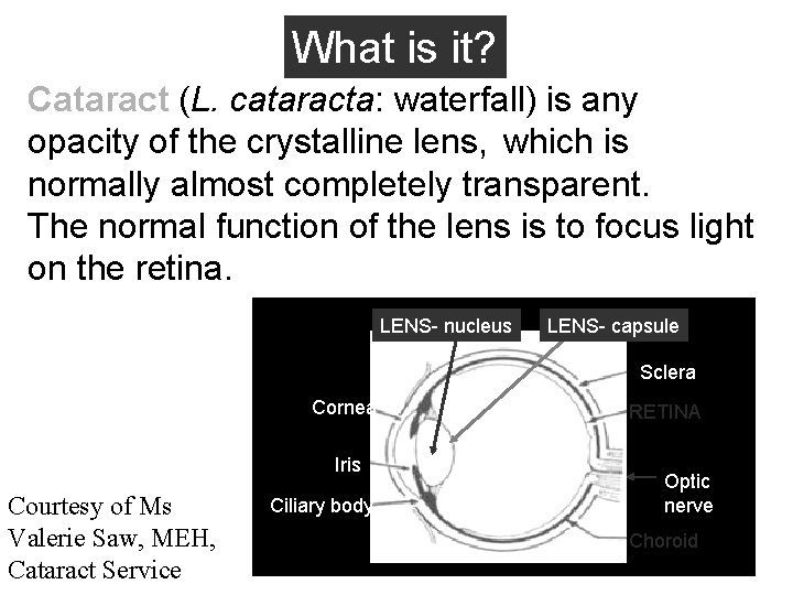 What is it? Cataract (L. cataracta: waterfall) is any opacity of the crystalline lens,