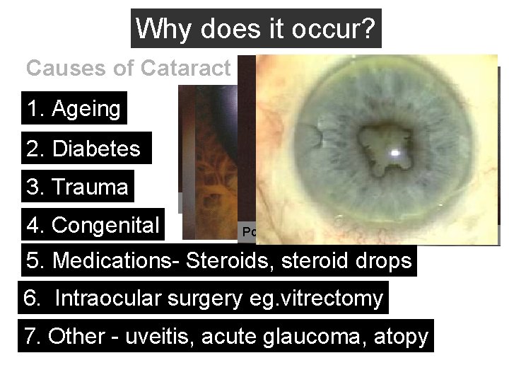 Why does it occur? Causes of Cataract 1. Ageing 2. Diabetes 3. Trauma 4.