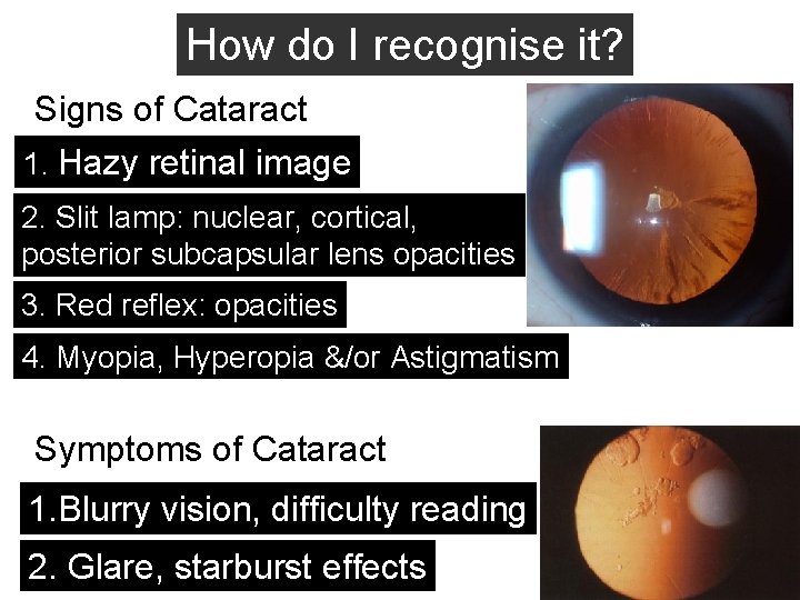 How do I recognise it? Signs of Cataract 1. Hazy retinal image 2. Slit