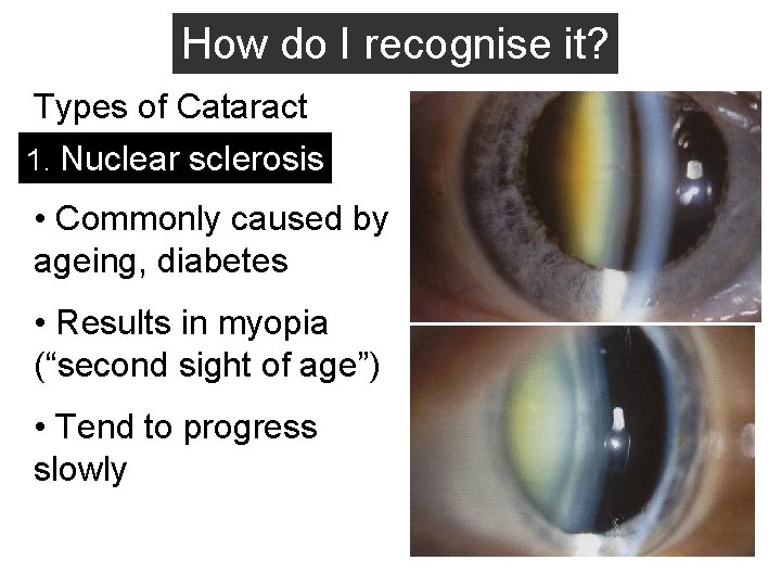 How do I recognise it? Types of Cataract 1. Nuclear sclerosis • Commonly caused