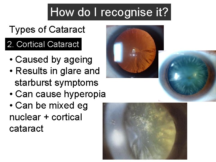 How do I recognise it? Types of Cataract 2. Cortical Cataract • Caused by