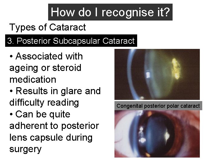 How do I recognise it? Types of Cataract 3. Posterior Subcapsular Cataract • Associated