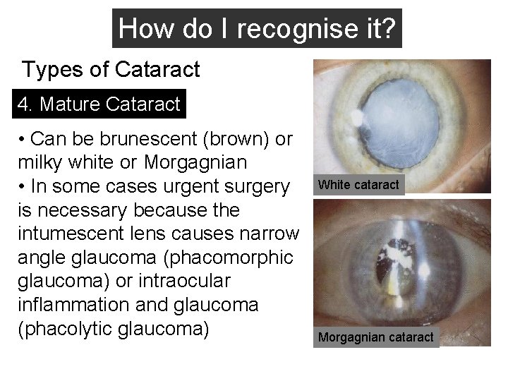 How do I recognise it? Types of Cataract 4. Mature Cataract • Can be