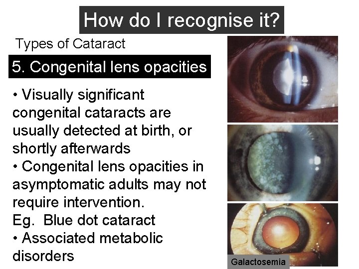 How do I recognise it? Types of Cataract 5. Congenital lens opacities • Visually
