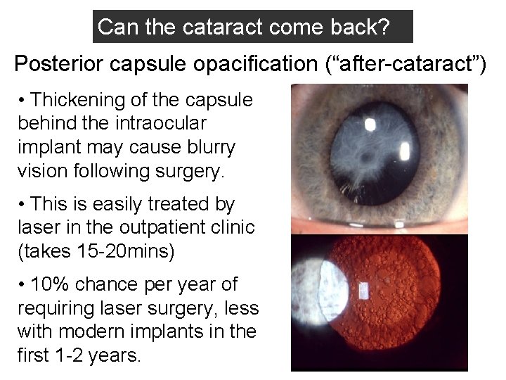 Can the cataract come back? Posterior capsule opacification (“after-cataract”) • Thickening of the capsule