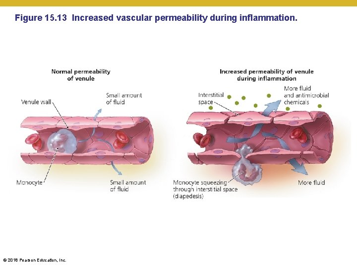 Figure 15. 13 Increased vascular permeability during inflammation. © 2018 Pearson Education, Inc. 