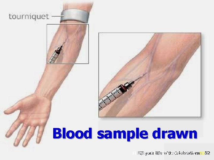 Blood sample drawn Fill your life with Celebrations 5252 