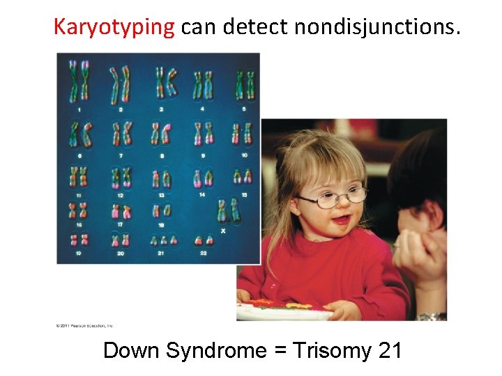 Karyotyping can detect nondisjunctions. Down Syndrome = Trisomy 21 