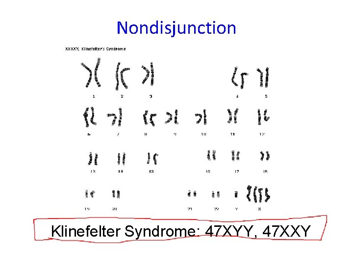 Nondisjunction Klinefelter Syndrome: 47 XYY, 47 XXY 