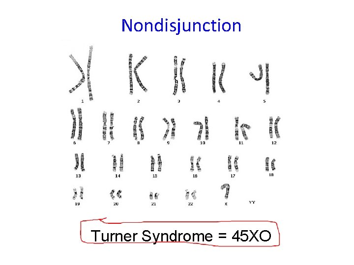 Nondisjunction Turner Syndrome = 45 XO 