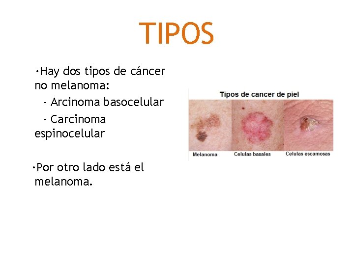 TIPOS ·Hay dos tipos de cáncer no melanoma: - Arcinoma basocelular - Carcinoma espinocelular