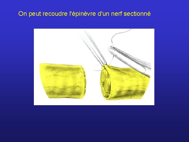 On peut recoudre l'épinèvre d'un nerf sectionné 