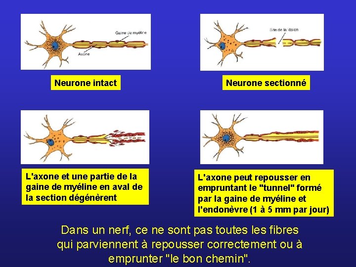 Neurone intact Neurone sectionné L'axone et une partie de la gaine de myéline en